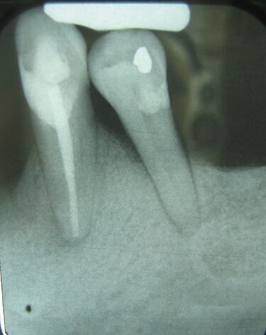 File:Periodontalboneloss.JPG