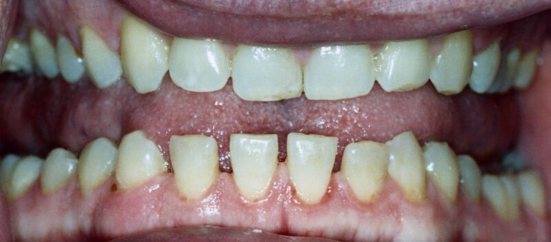 File:Acromegalyteethgapping.jpg