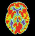 Normal brain PET scan