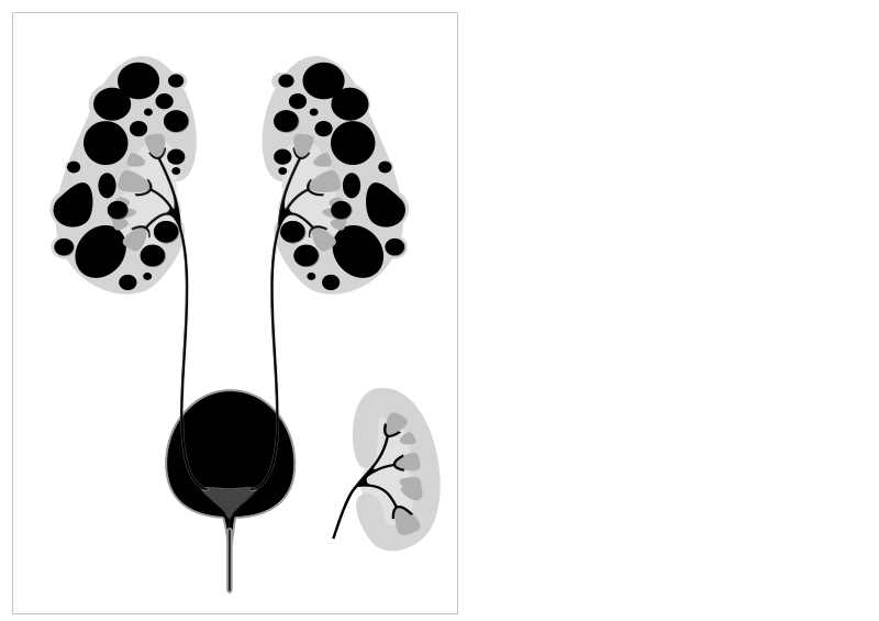File:Autosomal Dominant Polycystic Kidney Disease.svg