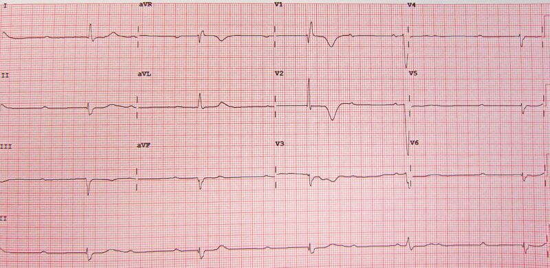File:CompleteHeartBlock.jpg