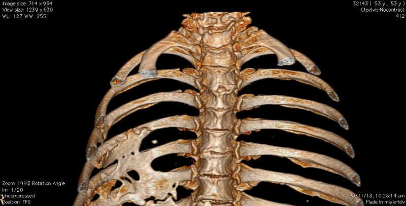 File:3DPOSTERIORRIBS (top) Nov 2018.jpg