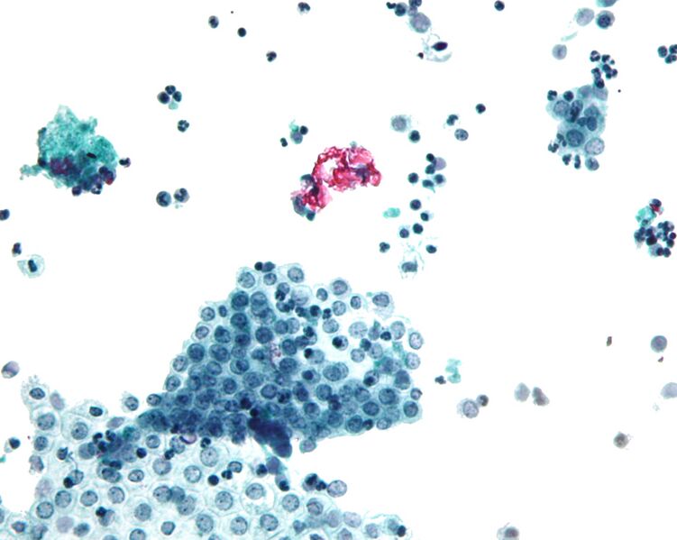 File:Mesothelium peritoneal wash high mag.jpg