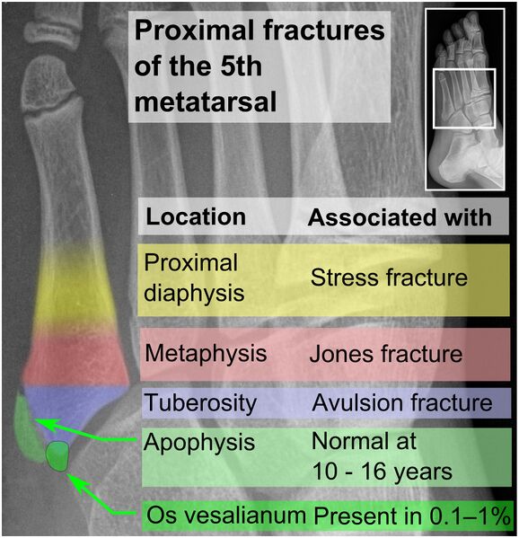 File:Proximal fractures of 5th metatarsal.jpg