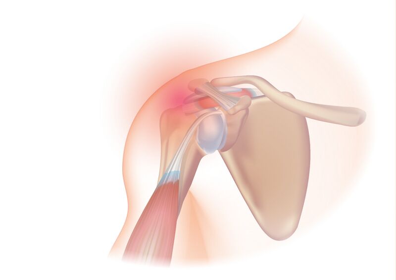 File:Rotator cuff syndrome.jpg