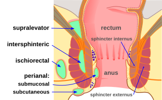 File:Abscess diag 02.svg
