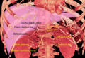 3D rendered CT of abdominal aortic branches and kidneys