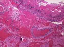 Histopathology of small bowel gangrene