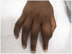 Dactylitis