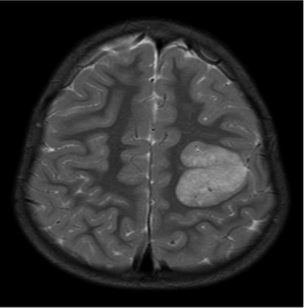 File:4-year-old-boy-with-angiocentric-glioma-Axial-T2weighted-image-shows-a-hyperintense.png