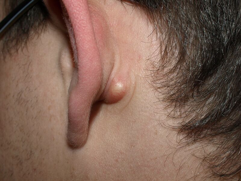 File:Sebaceous cyst01.jpg