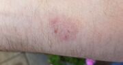 Dermatophytosis