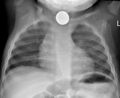 Endoscopic_foreign_body_retrieval
