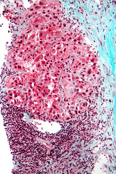 File:Hepatocellular carcinoma intermed mag.jpg