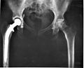 Hip replacement surgery