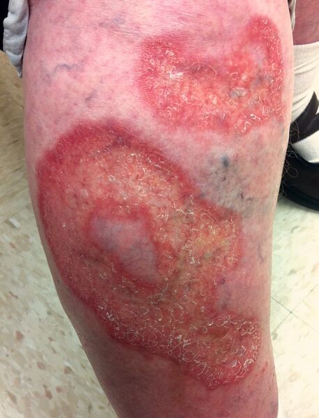 File:Necrobiosislipoidica.jpg