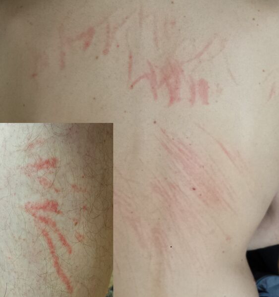 File:Shiitake mushroom dermatitis.jpg