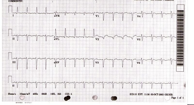 File:Takotsubo ECG.JPEG