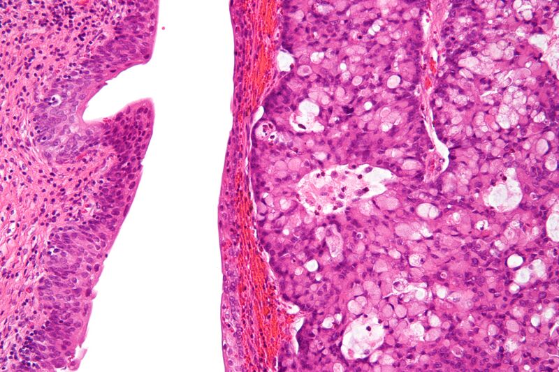 File:Urachal carcinoma - high mag.jpg