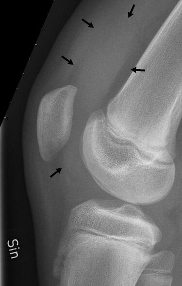 File:Knee effusion, annotated.jpg