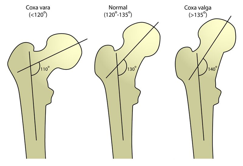 File:FemurAngles.jpg