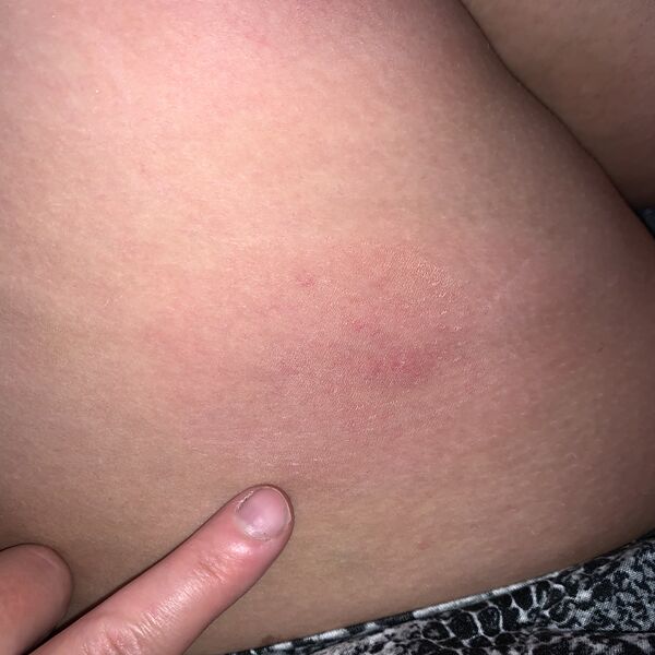 File:Severe mosquito bite reaction.jpeg