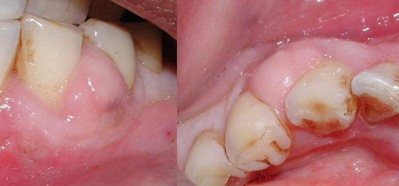 File:GingivalAbscess.jpg