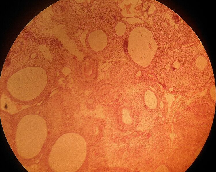 File:Adenomatoid odontogenic tumor.jpg