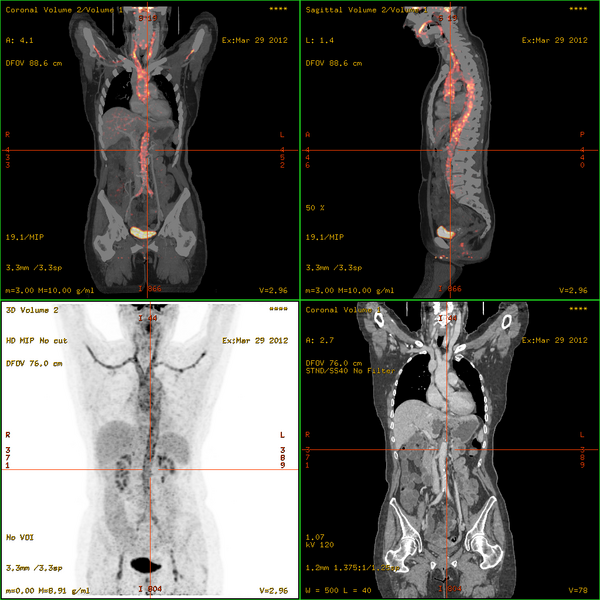 File:Vasculitis FDG PET-CT.png