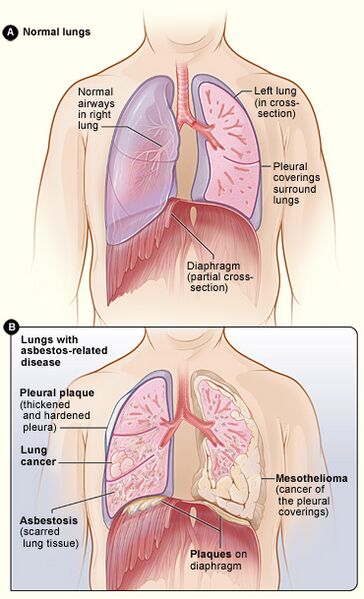 File:Asbestos effect.jpg