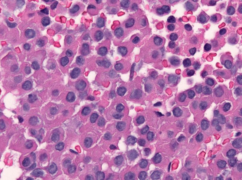 File:Densely granulated HGH producing adenoma.jpg
