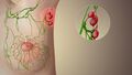 Sentinel lymph node