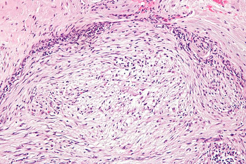 File:Nodular fasciitis - high mag.jpg
