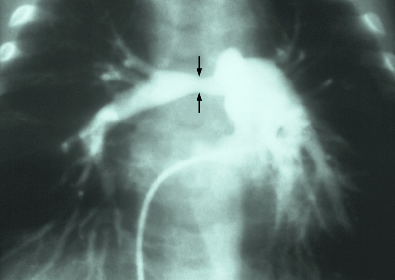 File:Stenosis of right pulmonary artery.png