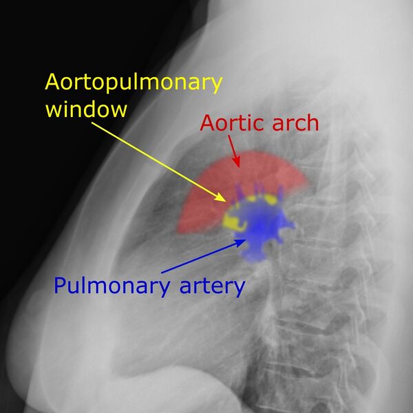 File:Aortopulmonary window.jpg