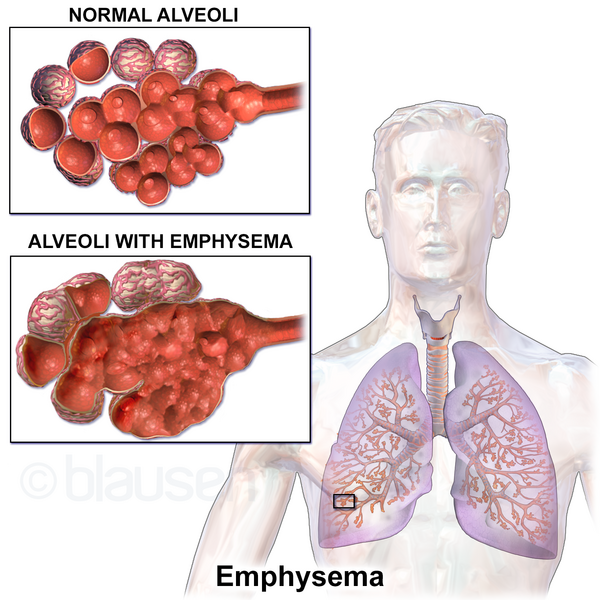 File:Blausen 0343 Emphysema.png