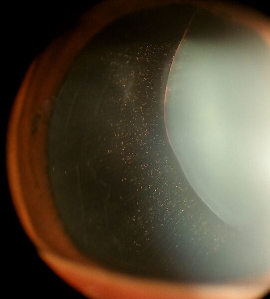 File:Ectopia Lentis in Marfan syndrome.jpg
