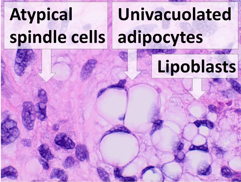 File:Histopathology of liposarcoma, annotated.jpg