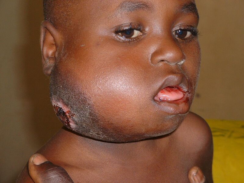 File:Large facial Burkitt's Lymphoma.JPG