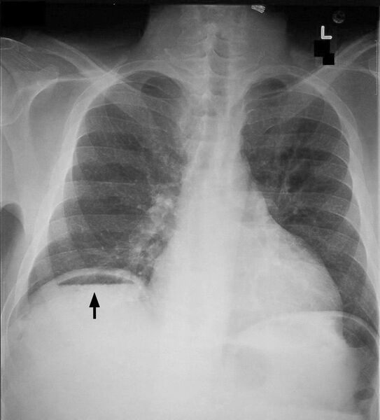 File:Pneumoperitoneum modification.jpg