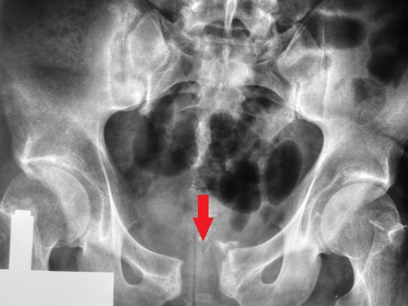 File:Diastasis symphysis pubis 1300500.JPG