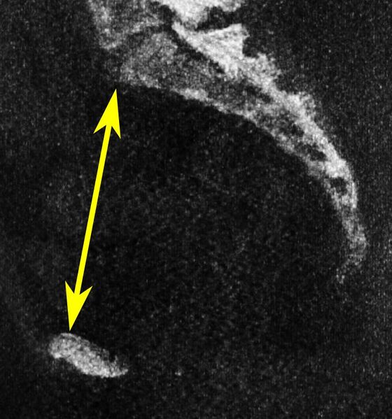 File:Low-dose CT of obstetric conjugate.jpg