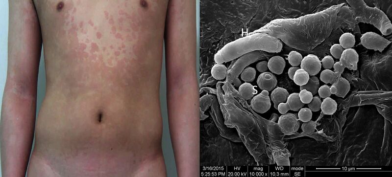 File:Malassezia spores 2.jpg