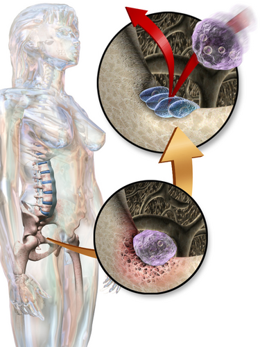 File:Osteoporosis Osteocytes.png