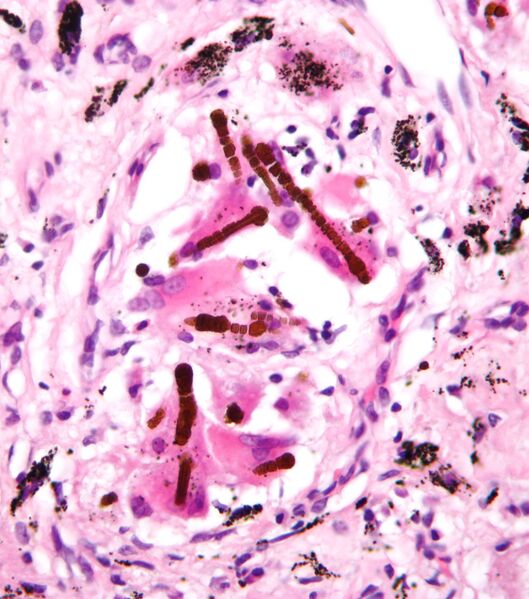 File:Ferruginous body.jpg