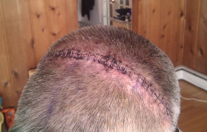 File:34 surgical staples, craniotomy.jpg