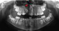 Cleft palate alveolus panorex x-ray