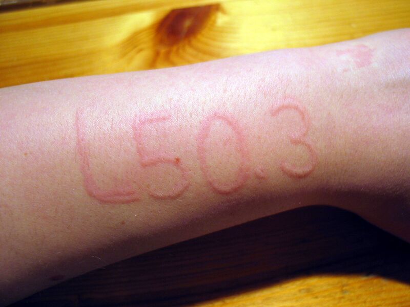 File:Dermatographic urticaria.jpg
