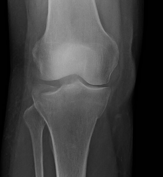 File:Tibial Plateau Fracture.jpg