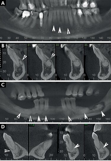 File:Periapical radiopaque-hyperdense jaw lesions 2.jpg